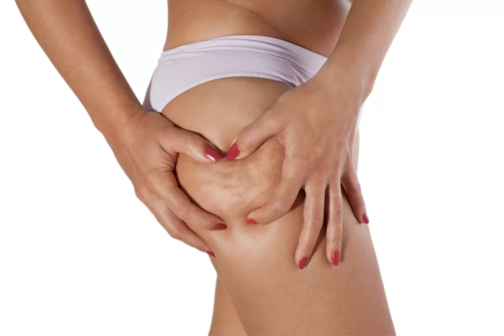 Comprendre la cellulite